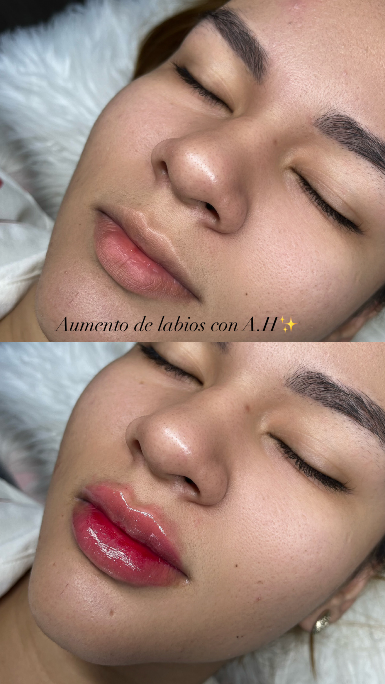Foto del servicio AUMENTO DE LABIOS