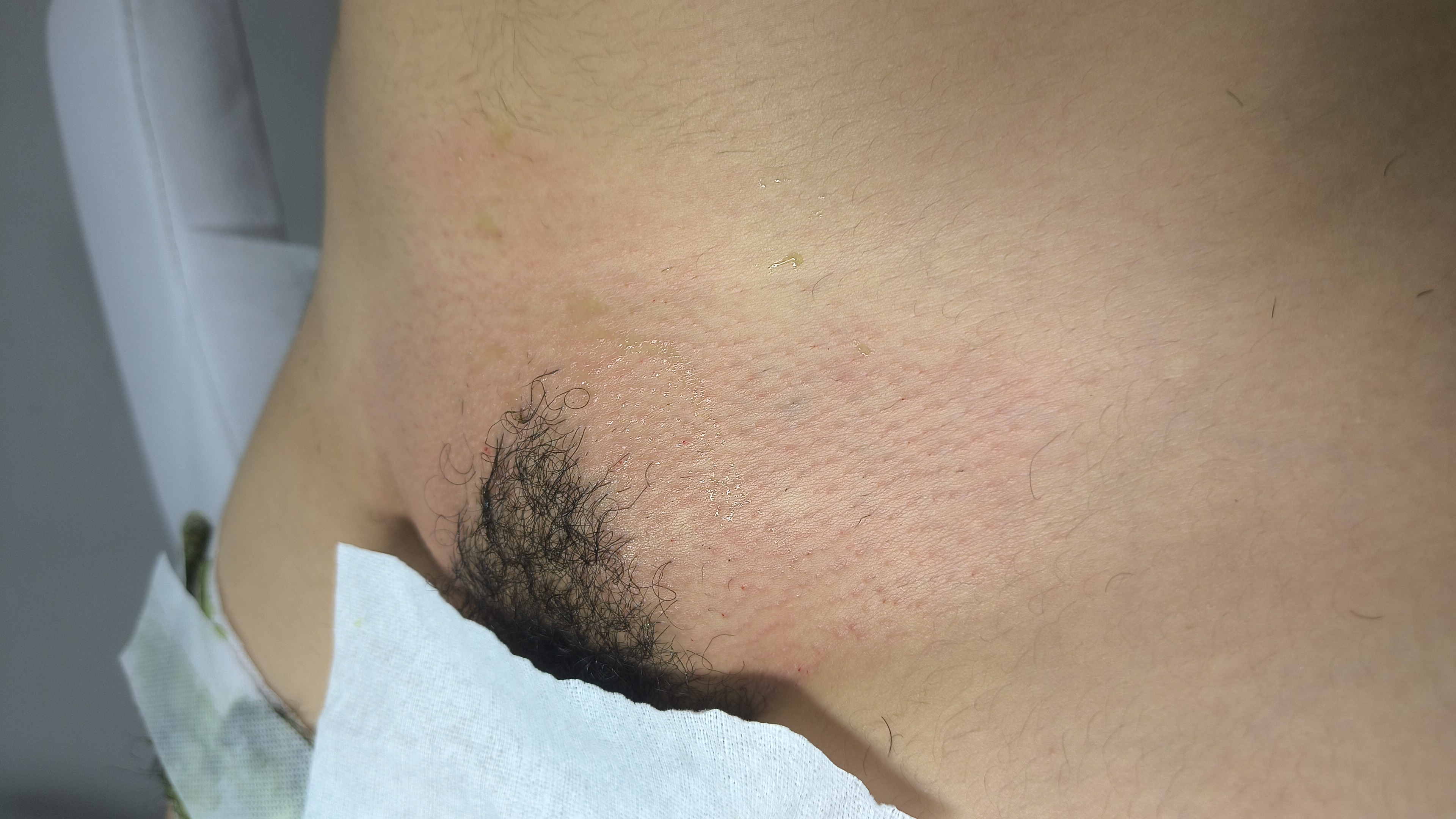 Foto del servicio LG|Bikini parcial