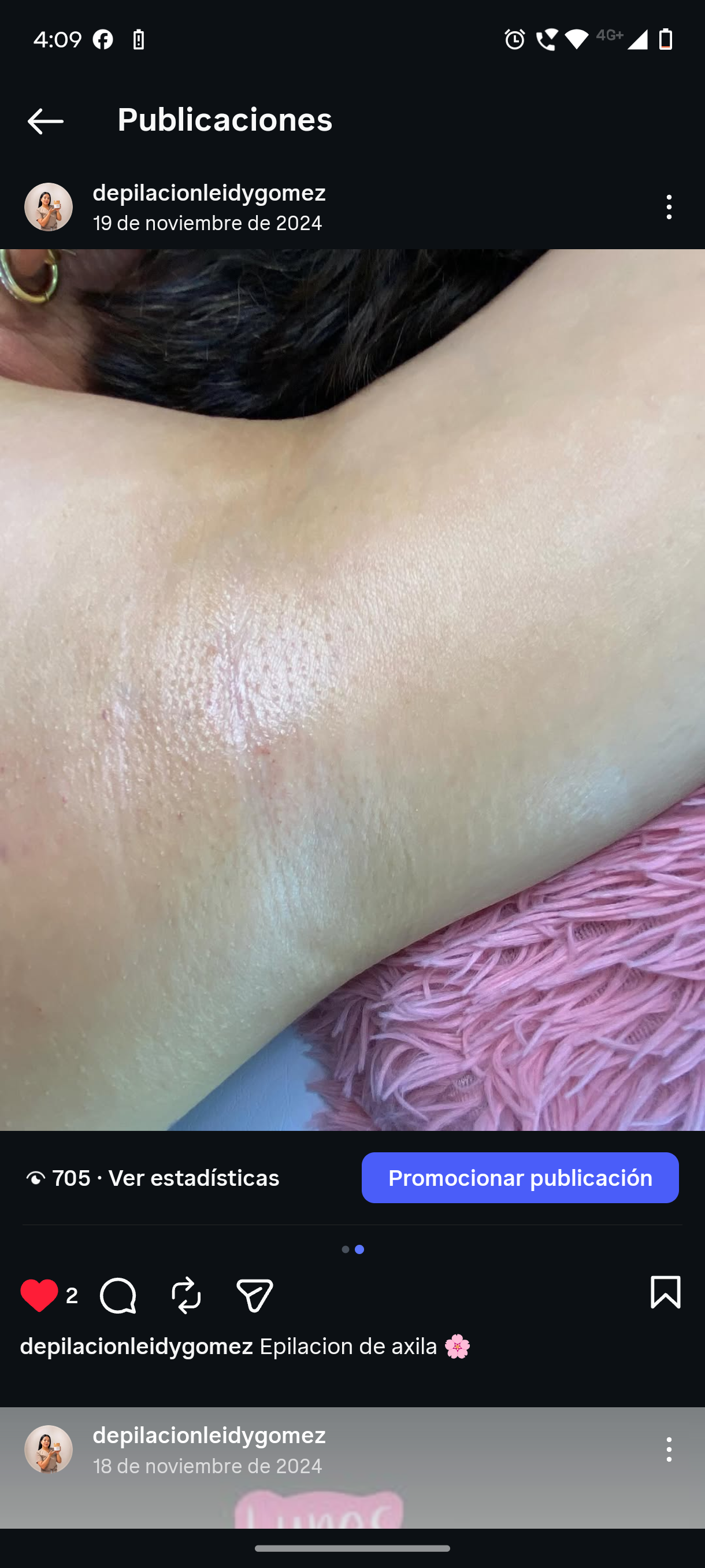 Foto del servicio Epilación axila