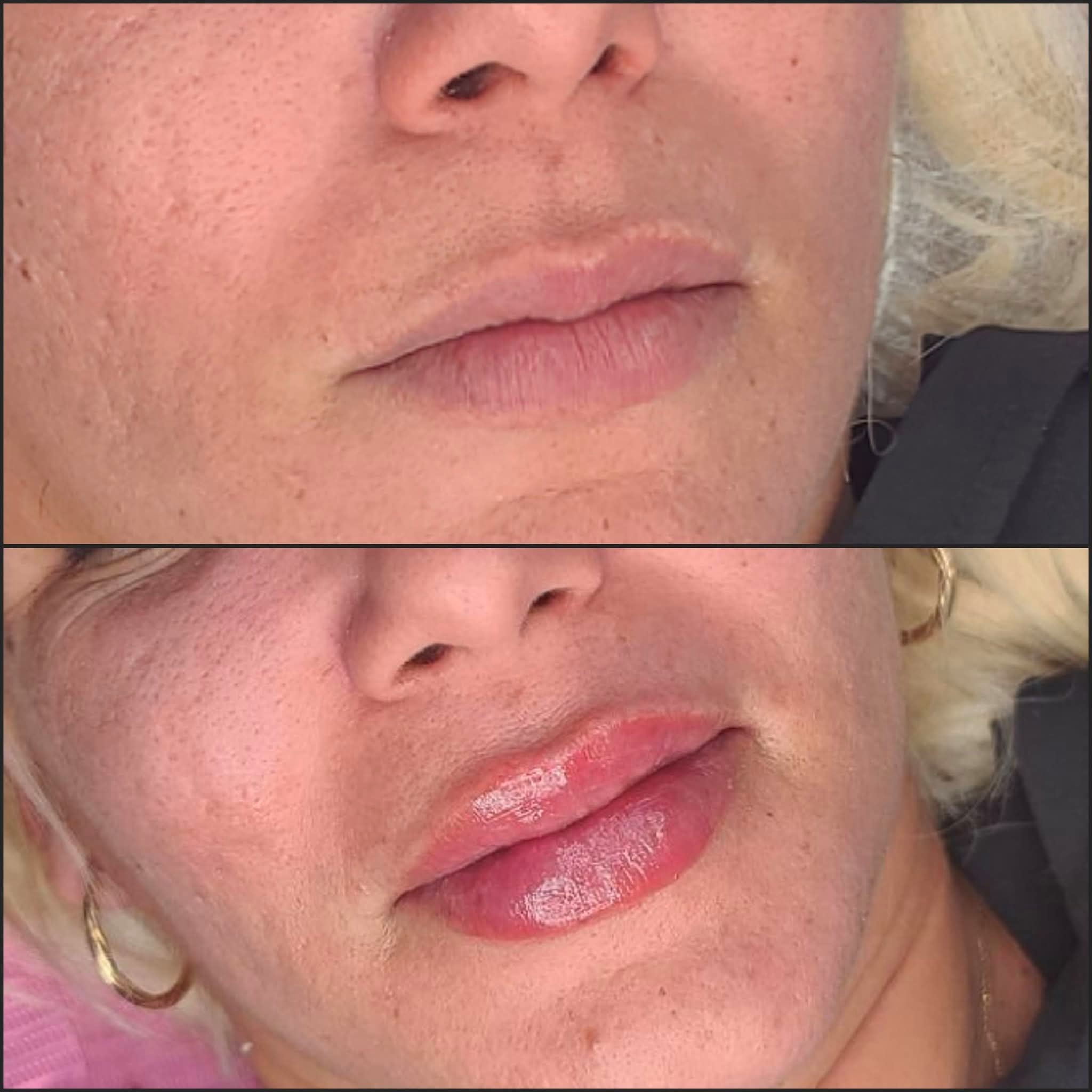 Foto del servicio Aumento de labios