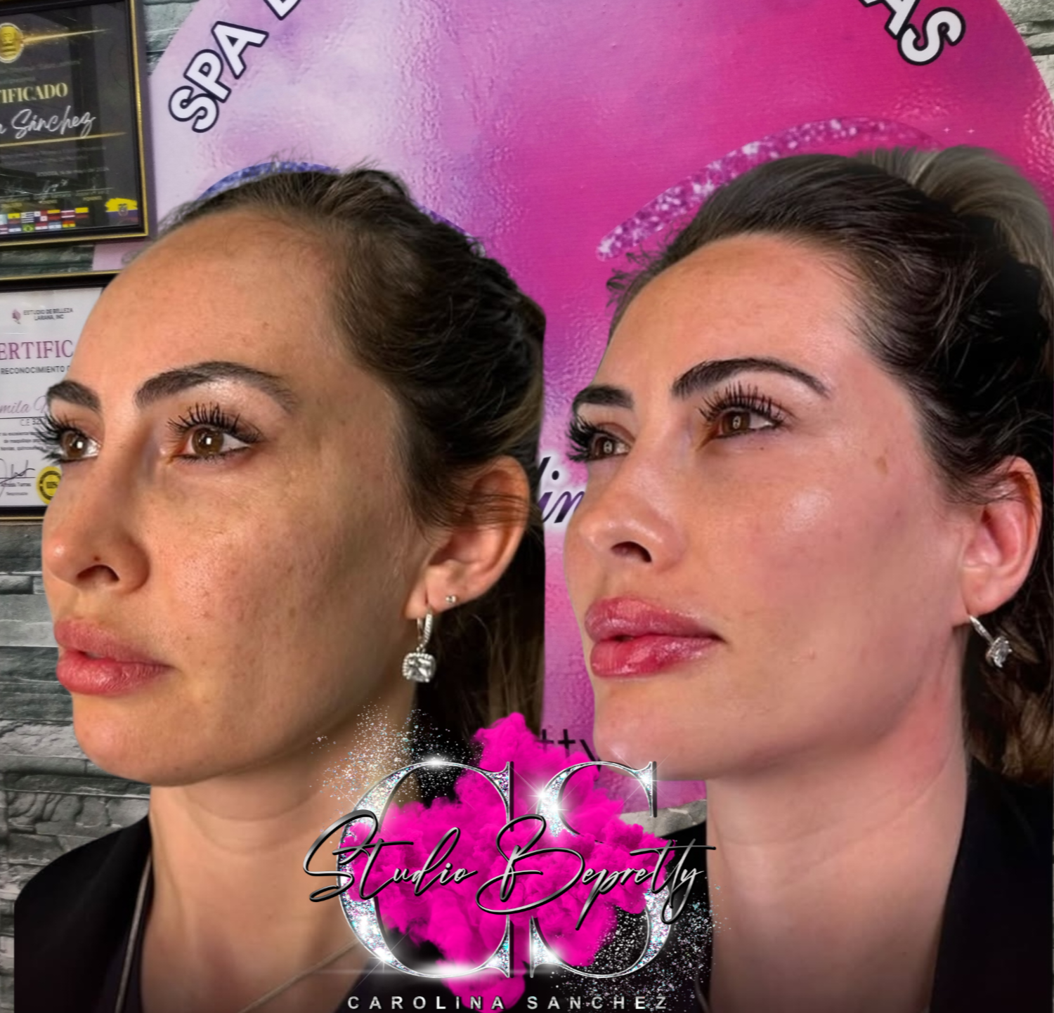 Foto del servicio Aumento de labios