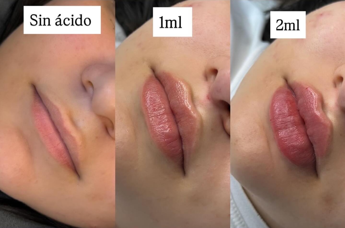Foto del servicio Aumento de labios