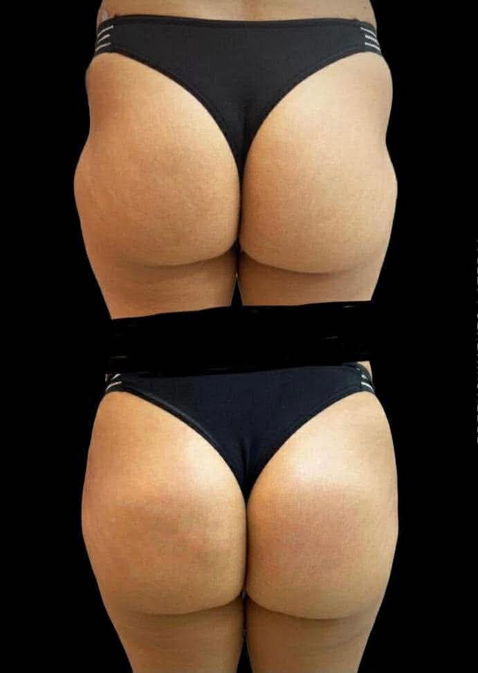 Foto del servicio Plasma gel en GLUTEOS