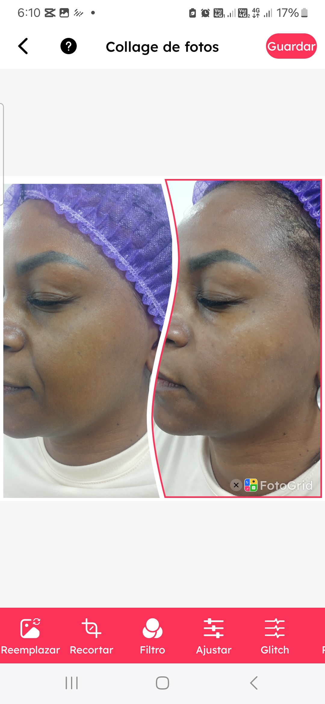 Foto del servicio Redensificacion facial