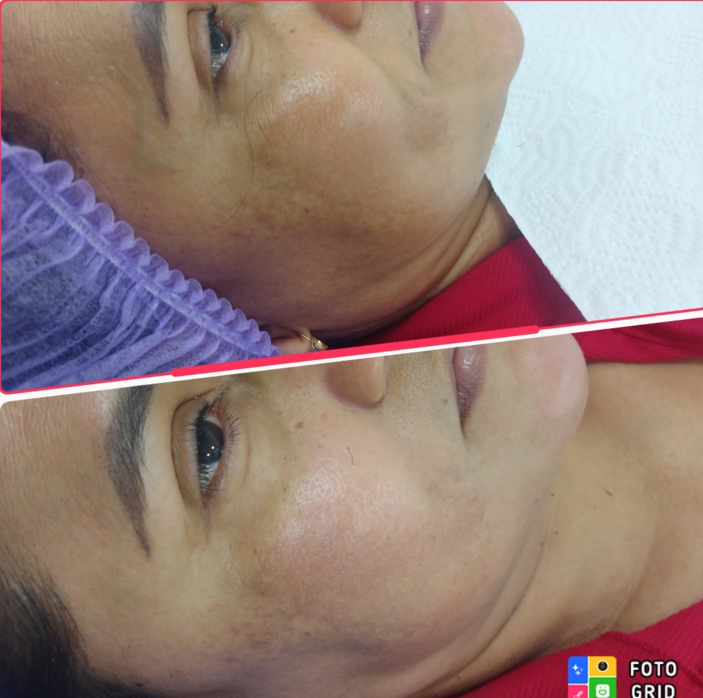 Foto del servicio Hidrafacial