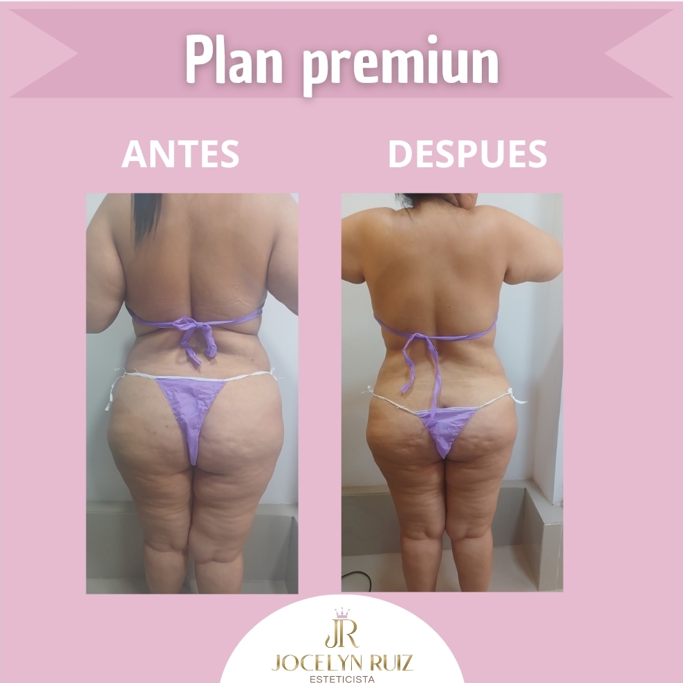 Foto del servicio Tratamiento reductor
