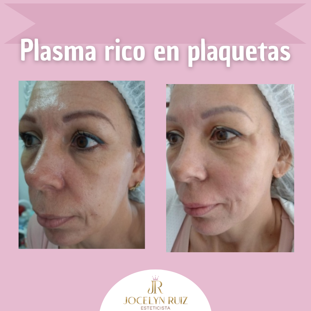 Foto del servicio Plasma rico en plaquetas