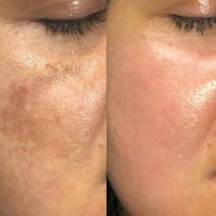 Foto del servicio Dermapen