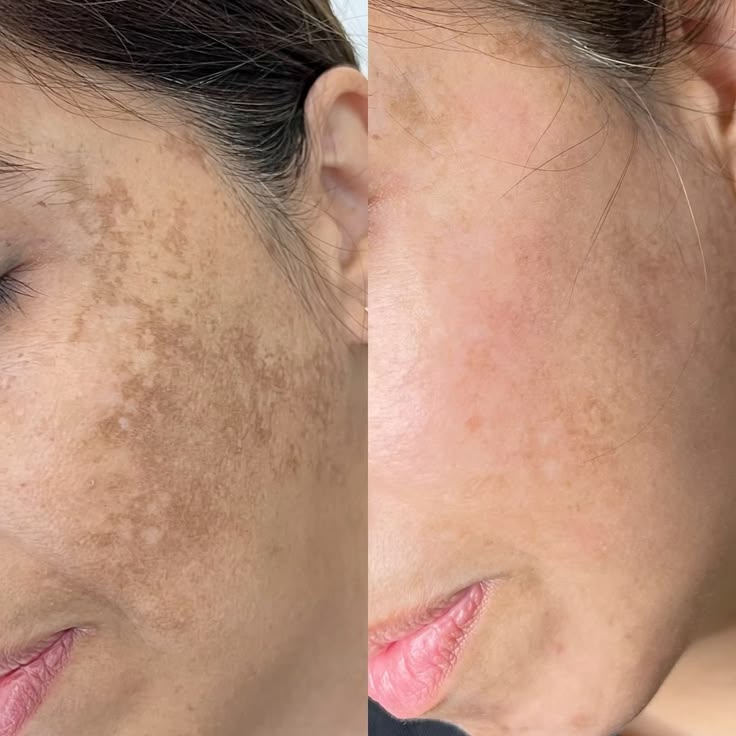 Foto del servicio Dermapen