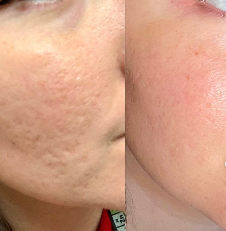 Foto del servicio Dermapen