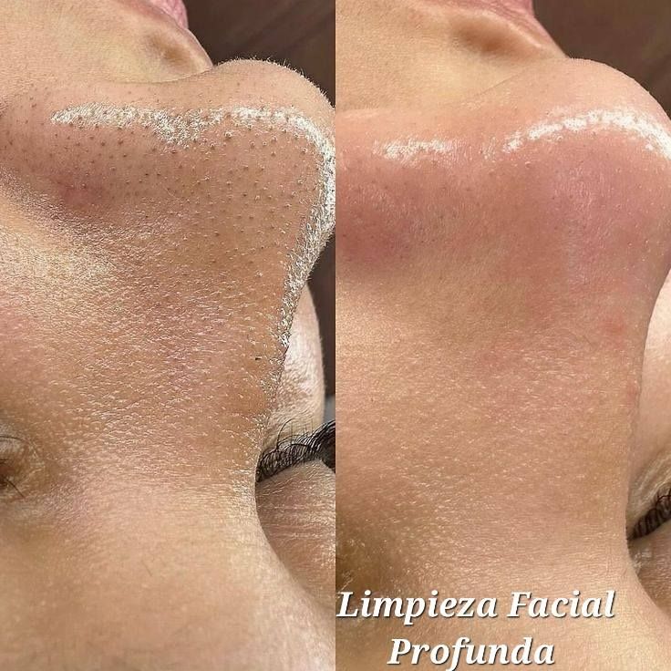 Foto del servicio Limpieza Facial Profunda