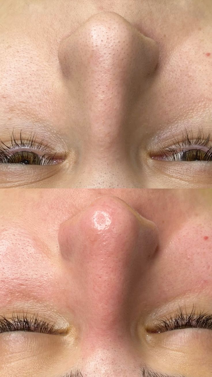 Foto del servicio Limpieza Facial Profunda