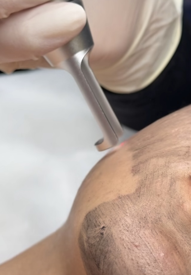 Foto del servicio Paquete Láser Hollywood Peel  X 6