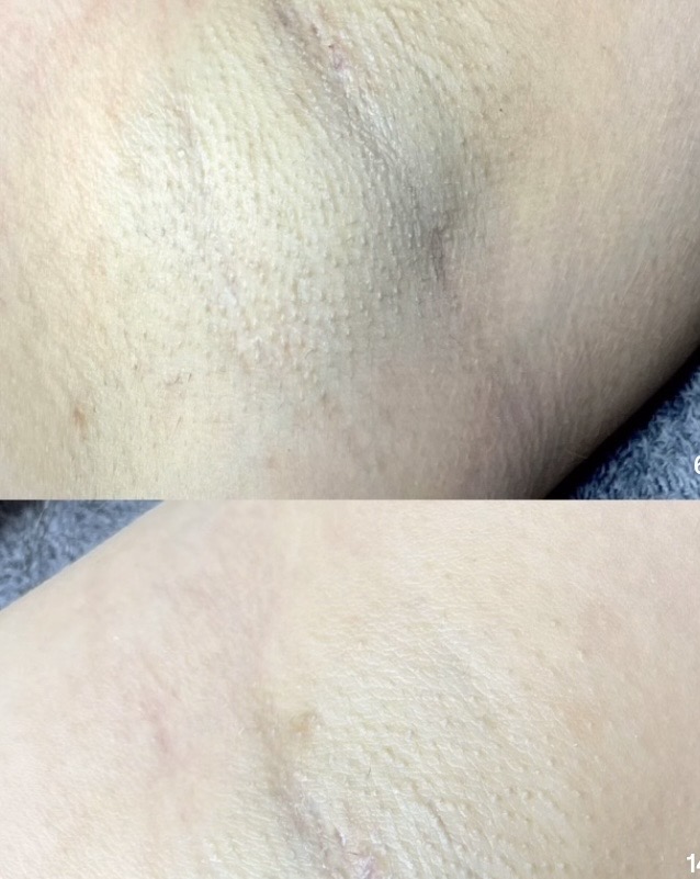 Foto del servicio Peeling Quimico