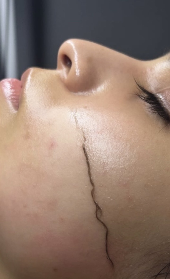 Foto del servicio Dermaplaning