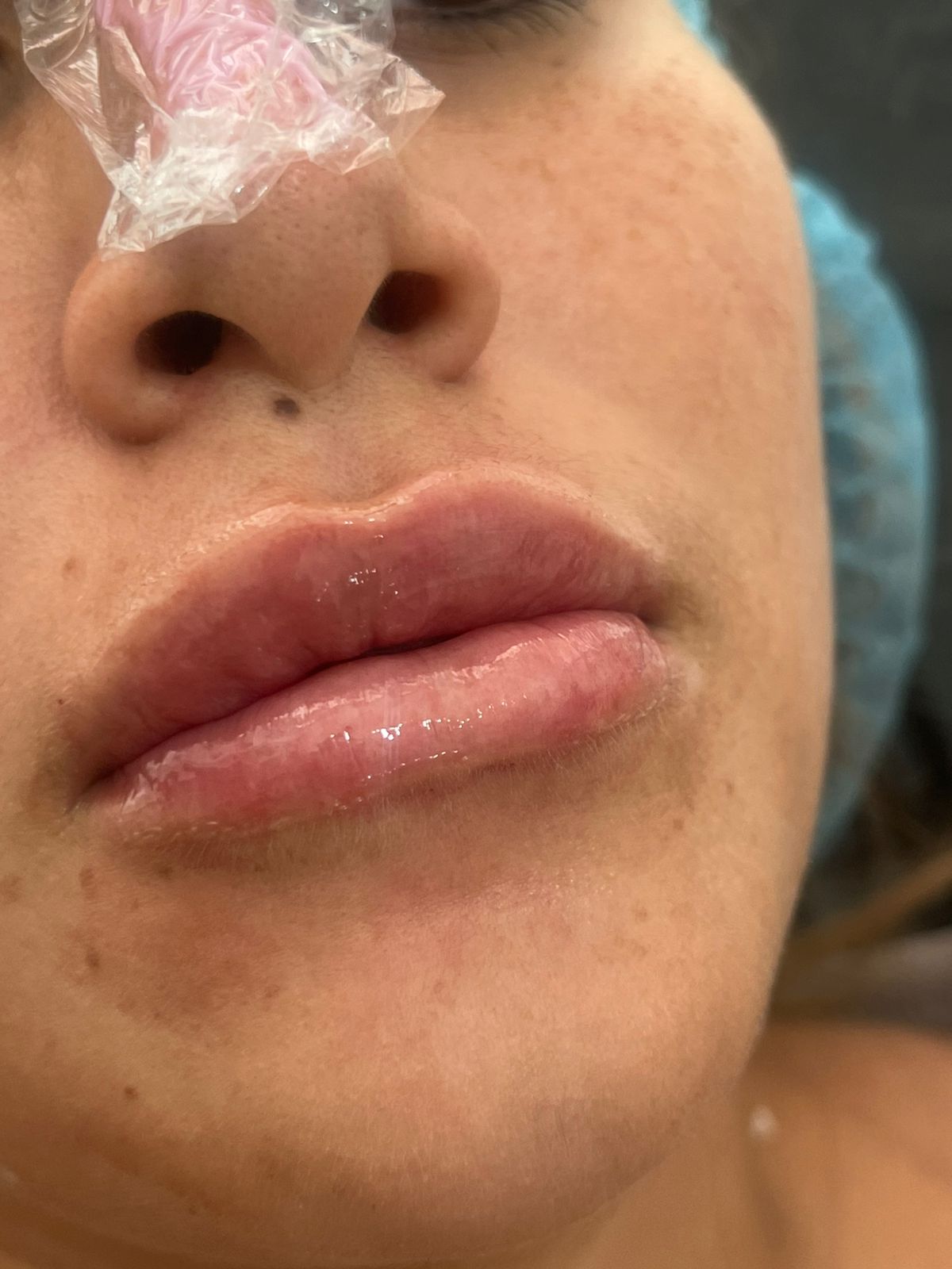 Foto del servicio Labios con ácido hialuronico
