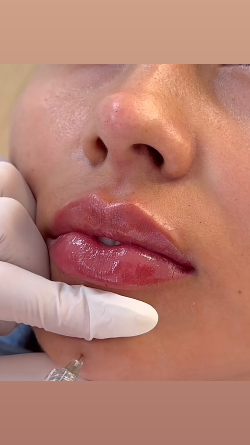 Foto del servicio Labios con ácido hialuronico