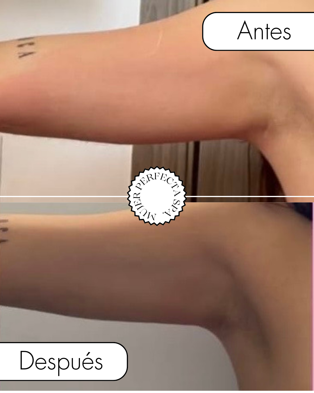 Foto del servicio DERMALIFT RF