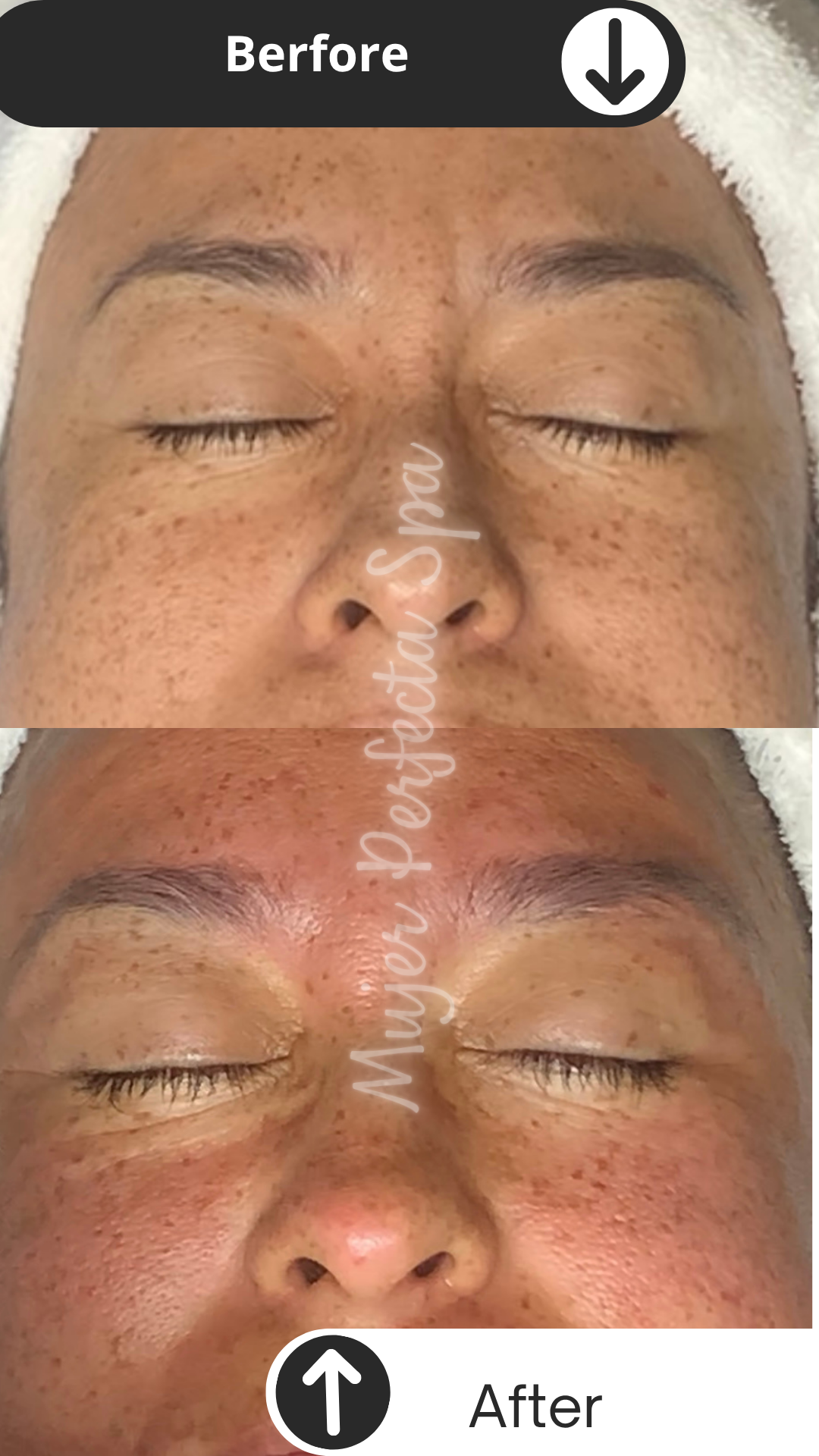 Foto del servicio MICRONEEDLING PRO