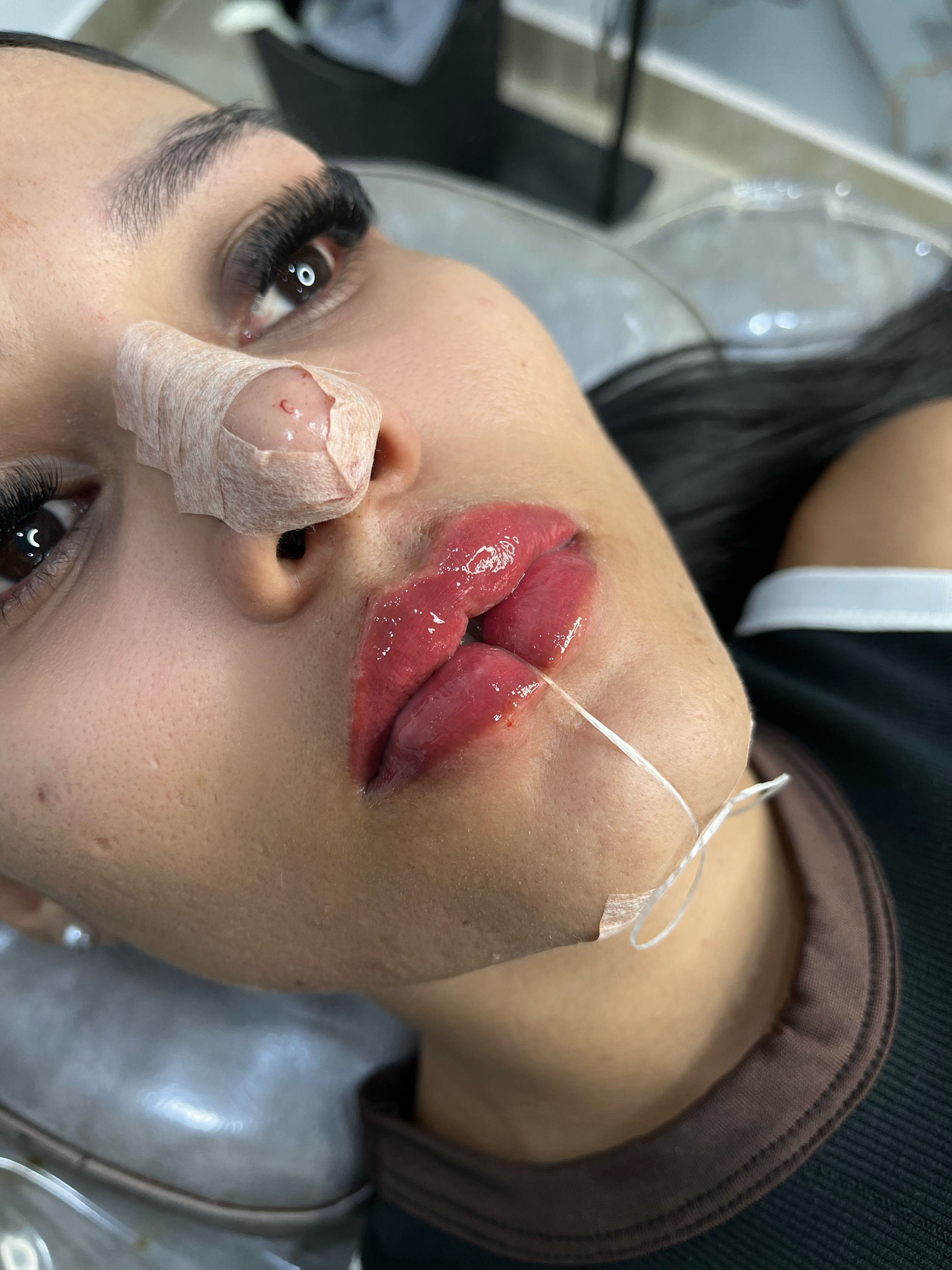 Foto del servicio AUMENTO DE LABIOS