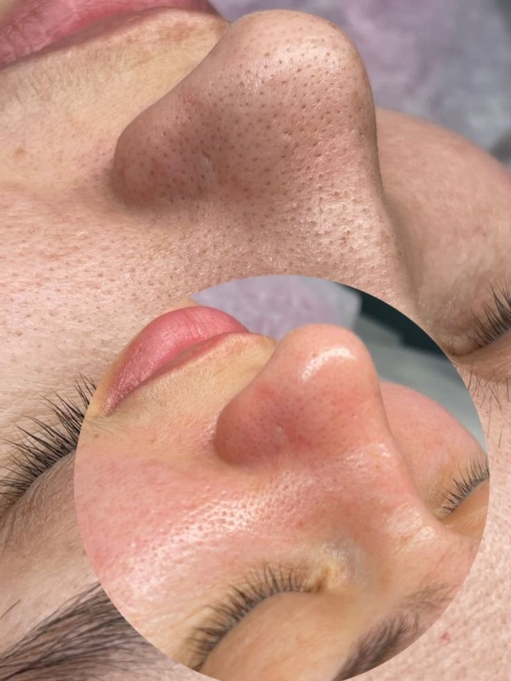 Foto del servicio Limpieza Facial Profunda ✨
