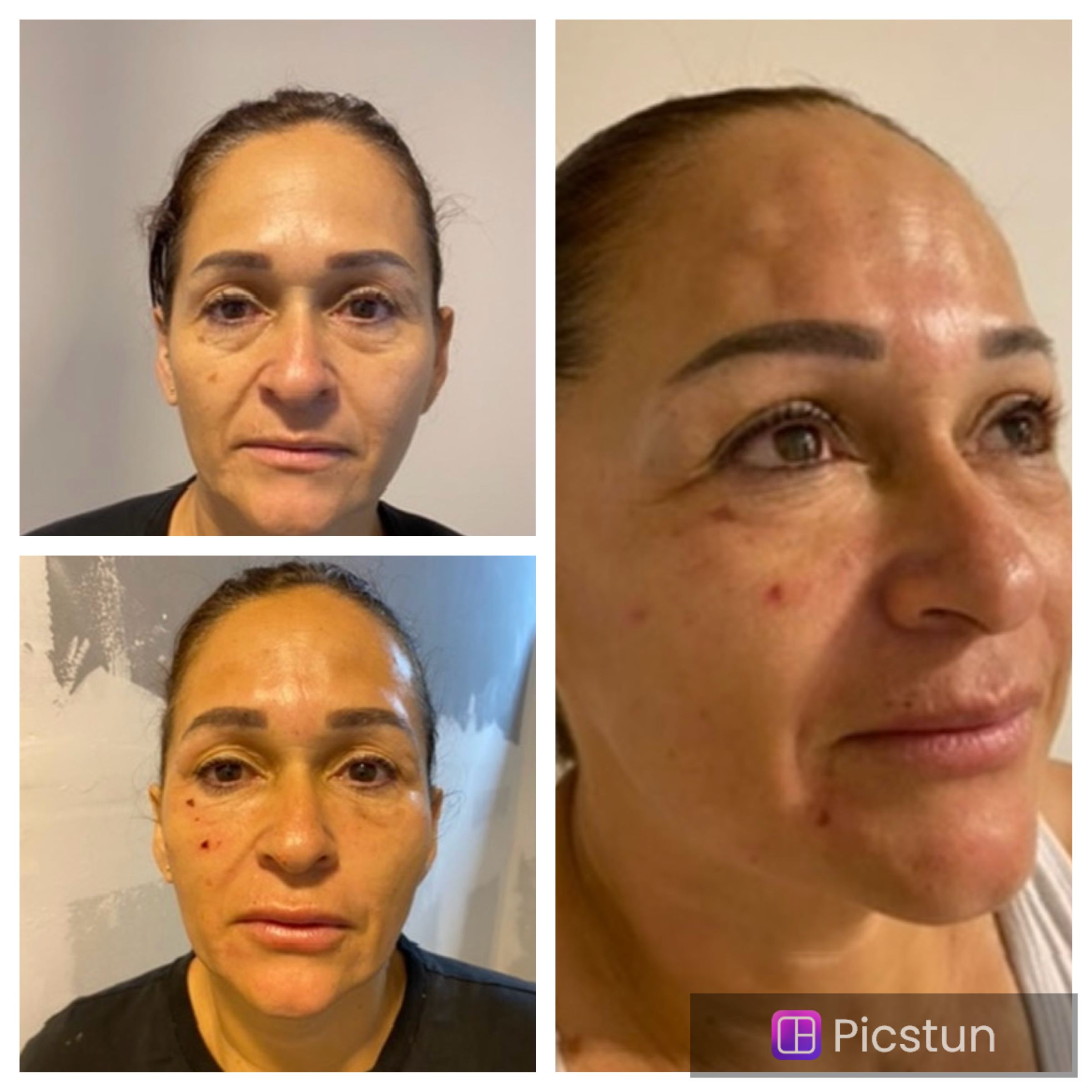 Foto del servicio Plasma rico en plaquetas vitamina C y aparatologia