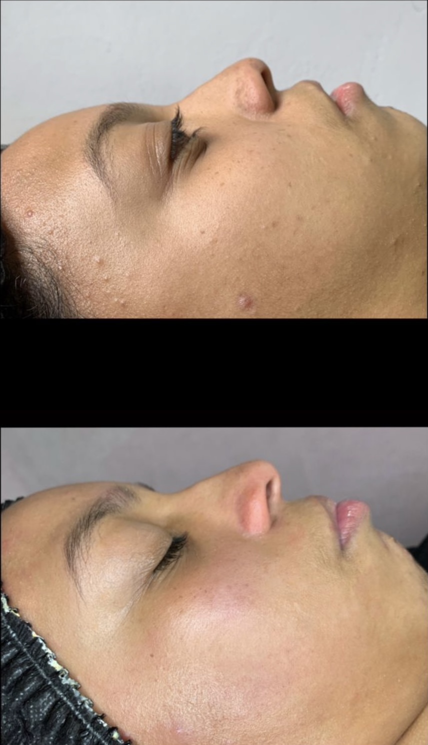 Foto del servicio Detox Facial Premium