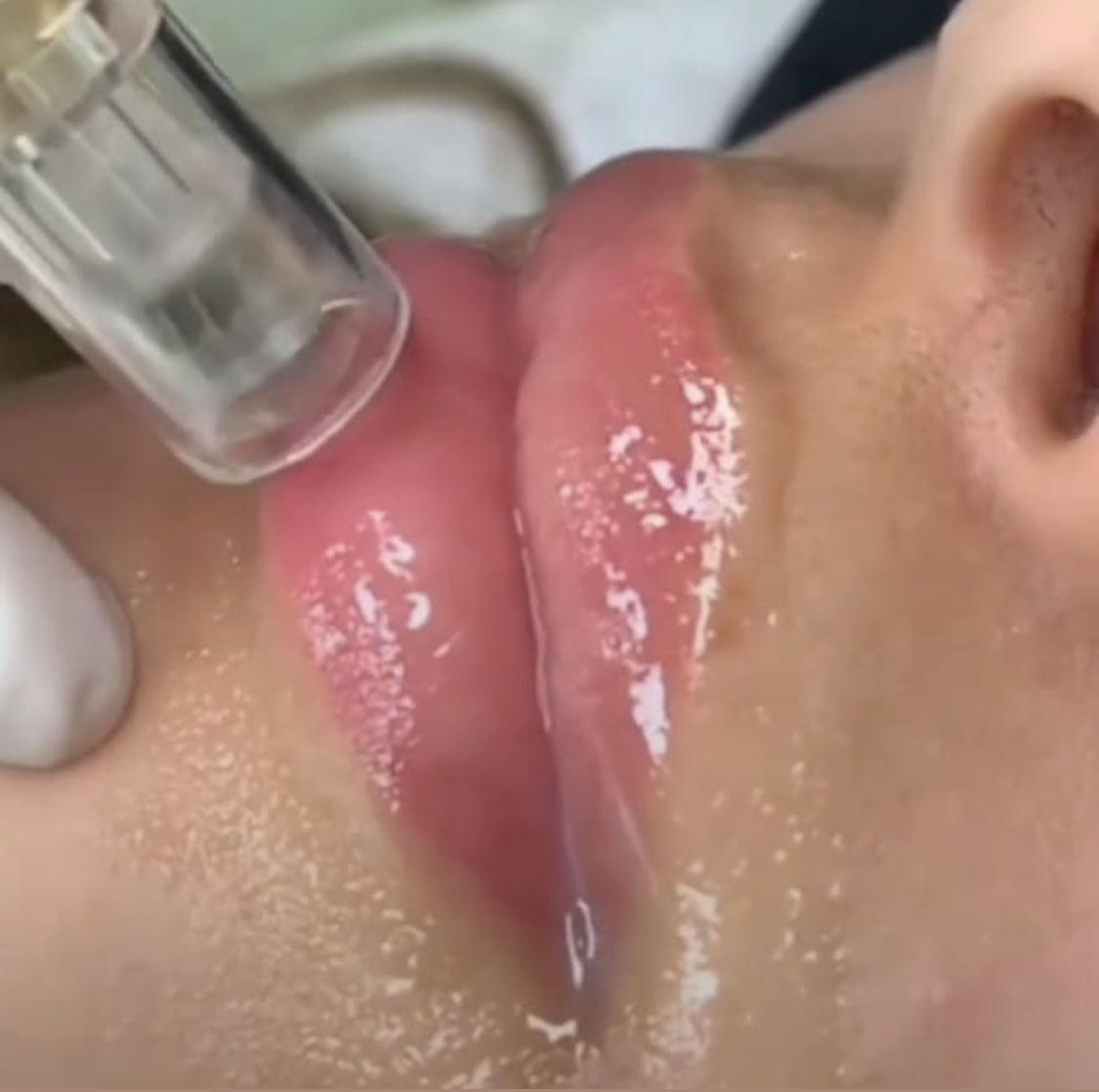 Foto del servicio Hidra Lips