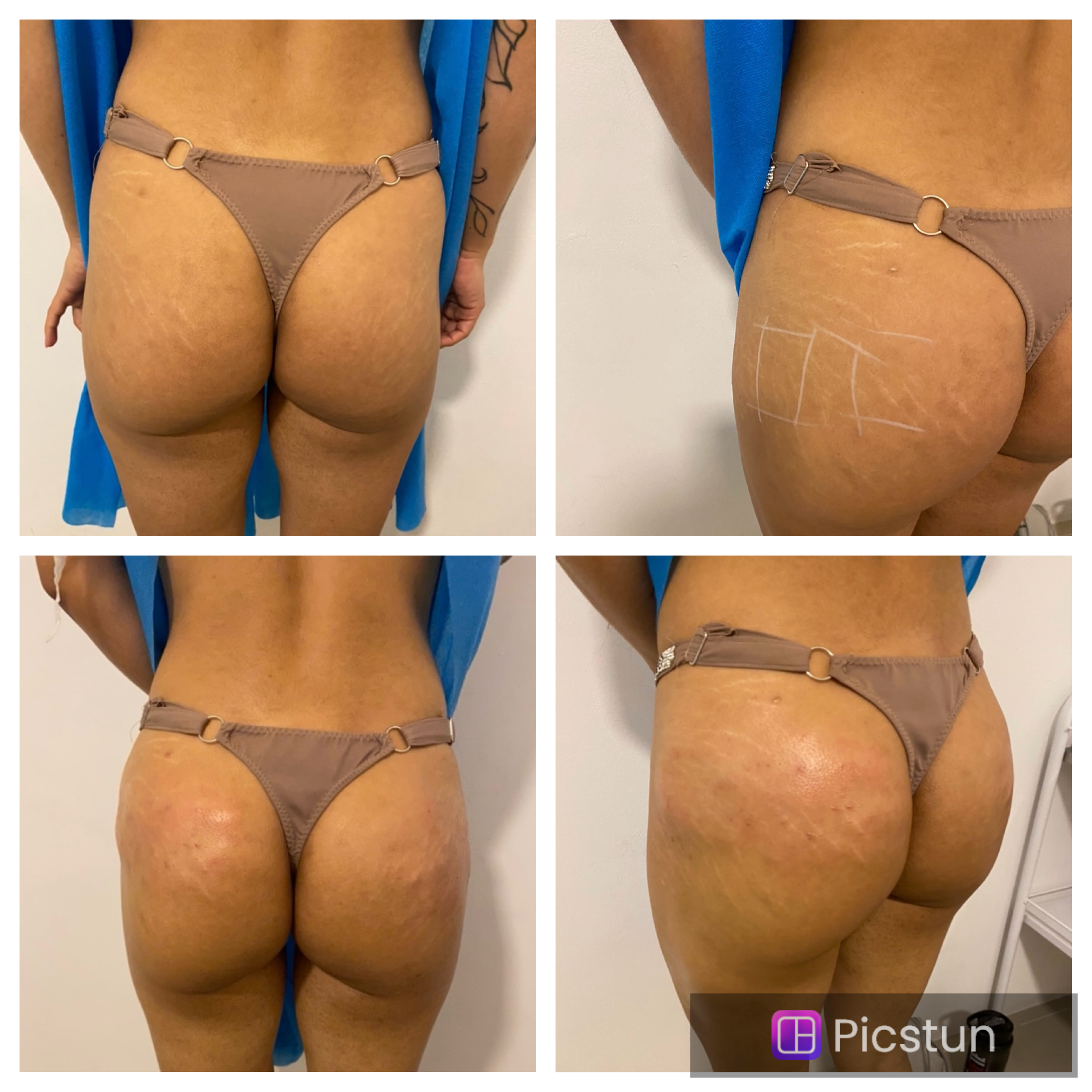 Foto del servicio Plasma gel en GLUTEOS