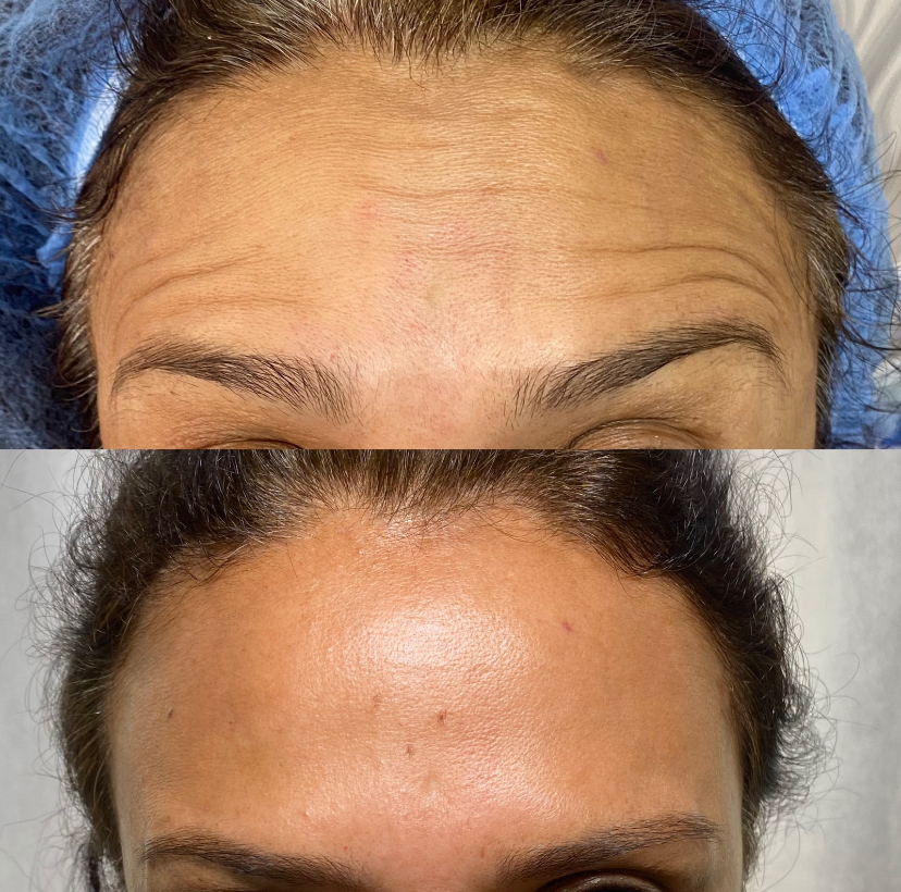 Foto del servicio Botox  toxina botulinica