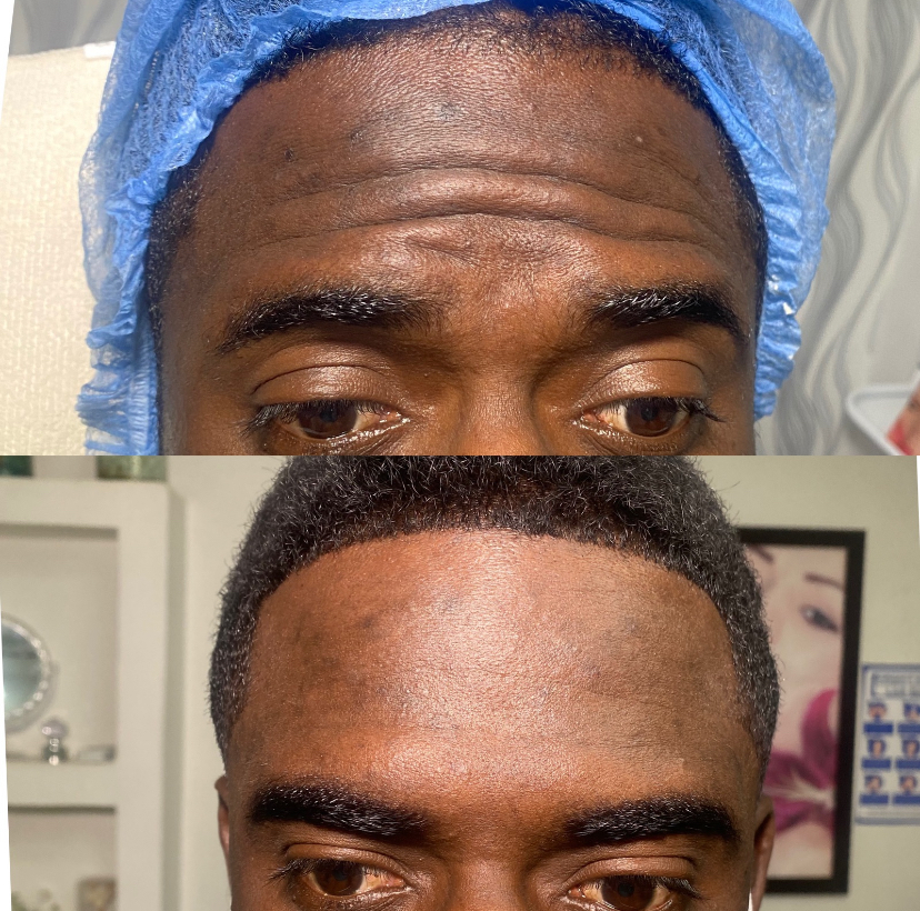 Foto del servicio Botox  toxina botulinica