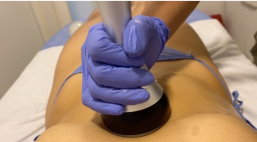 Foto del servicio Lipo Laser sin CIRUGÍA