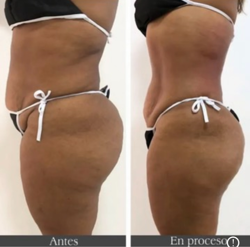 Foto del servicio Lipo Laser sin CIRUGÍA
