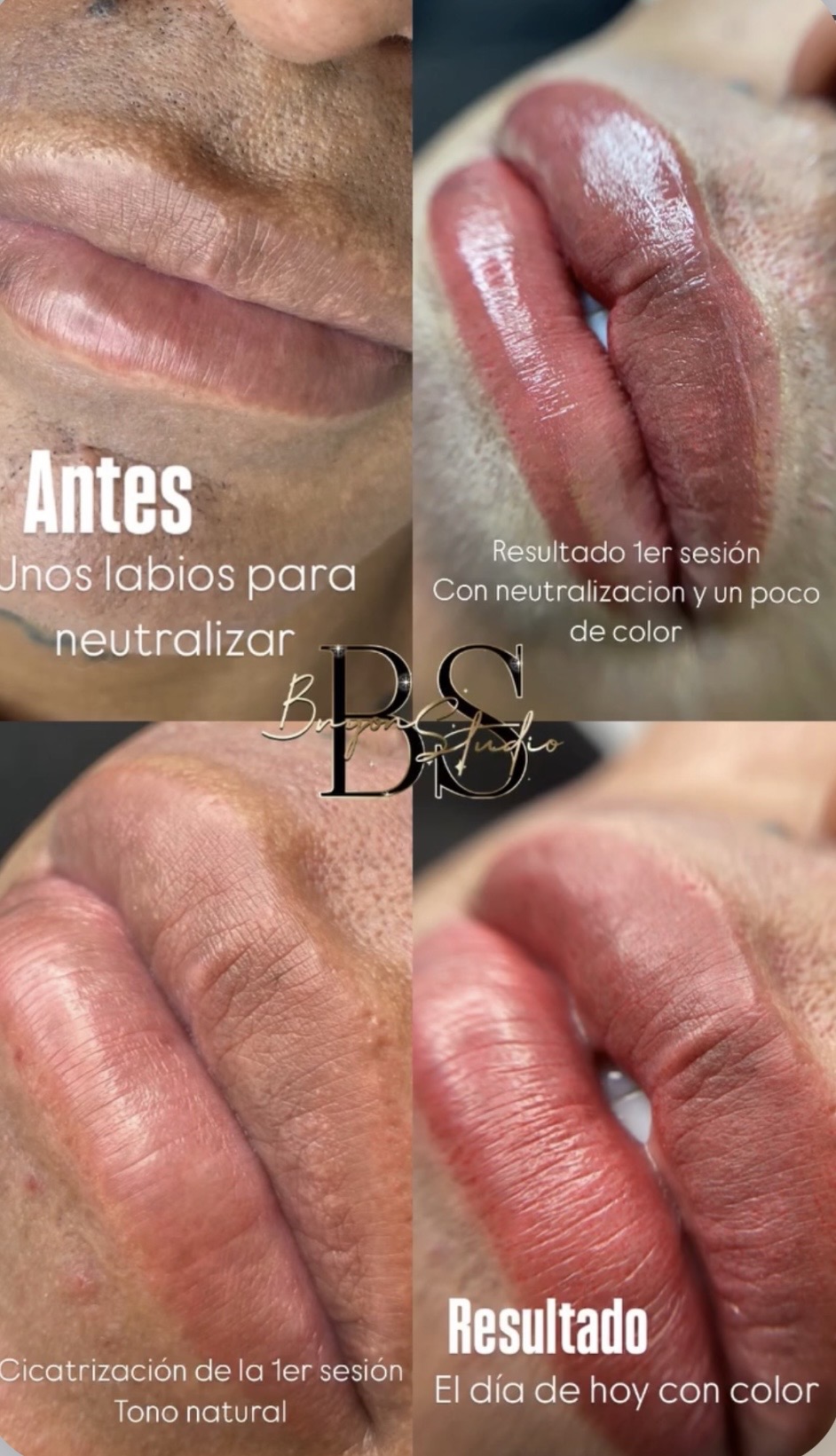 Foto del servicio Neutralización labios