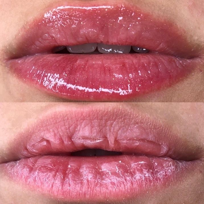Foto del servicio Hidra lips