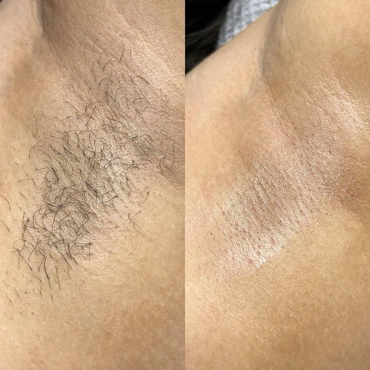 Foto del servicio Depilación Facial y Corporal